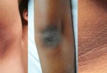 TAMNA MRLJA ISPOD PAZUHA MOŽE UKAZATI NA DIJABETES: Zahvaćena koža obično ima neprijatan MIRIS I BLAGI SVRAB