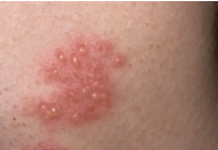 Najmoćniji PRIRODNI LIJEK za HERPES ZOSTER: uklonite ga zauvijek!