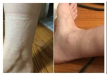 TRAGOVI OD ČARAPA NA VAŠIM NOGAMA: Evo šta to otkriva o vašem zdravlju, važan pokazatelj