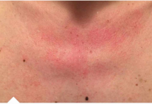 Zašto me tijelo svrbi nakon tuširanja? Ako i vi imate crvene mrlje, evo zašto