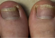 SINOĆ SAM NAMAZALA OVU SMJESU NA GLJIVICE NA NOKTIMA: One su nestale kao rukom odnesene, GENIJALAN RECEPT MI SPASIO ŽIVOT