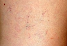 Prisutnost paučastih vena na licu služi kao ključni pokazatelj, signalizirajući mogućnost nadolazeće bolesti.