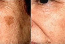 POZNATI DERMATOLOG OTKRIO: Ovo je uloga sode bikarbone u liječenju mrlja na licu!