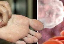 HOLESTEROL SE TEŠKO OTKRIVA, A STVARA MNOGE POSLJEDICE: Kardiolozi upozoravaju da se prvi simptom javlja u OVOM DIJELU TIJELA