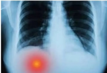 BOLI LI VAS ISPOD DESNOG REBRA? TO MOŽE BITI OZBILJAN PROBLEM: Većina ljudi nije svjesno da se BOLEST razvila do PRVE FAZE