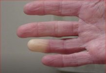 4 razloga zašto imate hladne ruke i stopala: To je simptom, evo šta se dešava u vašem telu