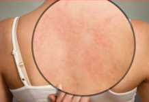 Da li vas koža iznenada svrbi nakon tuširanja? Doktor je objasnio šta se dogodilo