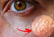 Rijetko ko zna šta su BIJELE TAČKICE na licu, a upozoravaju na 0PASNO STANJE – Ako ih imate, 0bratite pažnju