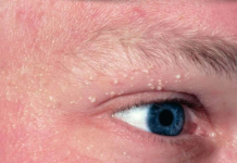 Bijele tačkice 0ko očiju ne stiskajte sami: Milije nisu bubuljice, samo ovako ih se možete riješiti