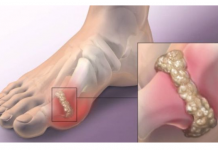 Kako smanjiti nivo mokraćne kiseline u tijelu i spriječiti giht: 3 narodna lijeka koja provjereno djeluju!