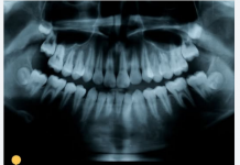 Japan počeo ljudska ispitivanja lijeka koji potiče rast prirodnih zuba: kraj implantata kakve znamo?