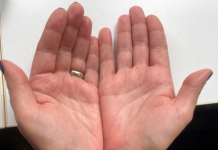 AKO IMATE CRVENE DLANOVE, ODMAH IZVADITE KRV: Ovaj simptom upozorava da vam jedan organ otkazuje