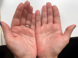 AKO IMATE CRVENE DLANOVE, ODMAH IZVADITE KRV: Ovaj simptom upozorava da vam jedan organ otkazuje