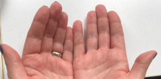 AKO IMATE CRVENE DLANOVE, ODMAH IZVADITE KRV: Ovaj simptom upozorava da vam jedan organ otkazuje