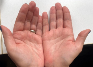 AKO IMATE CRVENE DLANOVE, ODMAH IZVADITE KRV: Ovaj simptom upozorava da vam jedan organ otkazuje