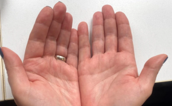 AKO IMATE CRVENE DLANOVE, ODMAH IZVADITE KRV: Ovaj simptom upozorava da vam jedan organ otkazuje