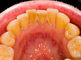 Evo kako sami da skinete kamenac sa zuba. Ove jeftine sastojke već imate kod kuće! (FOTO)