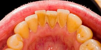 Evo kako sami da skinete kamenac sa zuba. Ove jeftine sastojke već imate kod kuće! (FOTO)