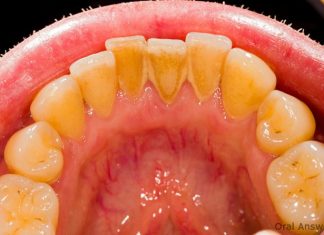 Evo kako sami da skinete kamenac sa zuba. Ove jeftine sastojke već imate kod kuće! (FOTO)