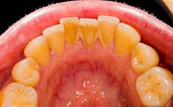 Evo kako sami da skinete kamenac sa zuba. Ove jeftine sastojke već imate kod kuće! (FOTO)